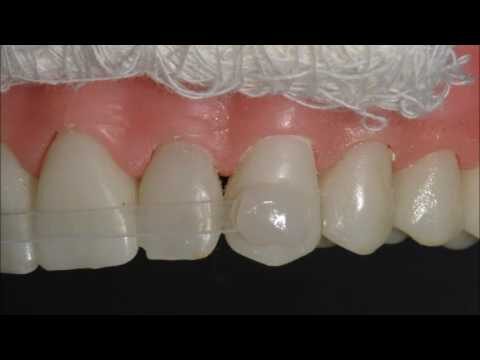 Contenções Dentárias: Importância e Tipos